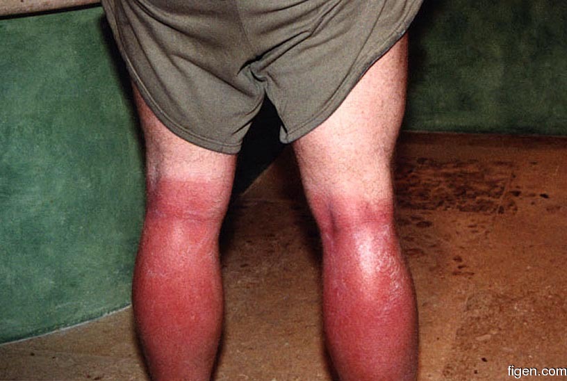 big_990405-mexico-pdc-sunburn.jpg